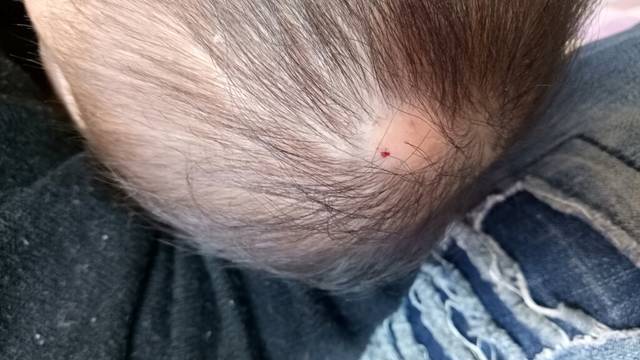 宝宝头上缺一块头发_宝宝刚出生头顶就就有硬