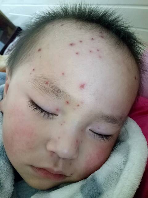 宝宝两岁发水痘_姐姐在幼儿园被传染,姐姐刚好