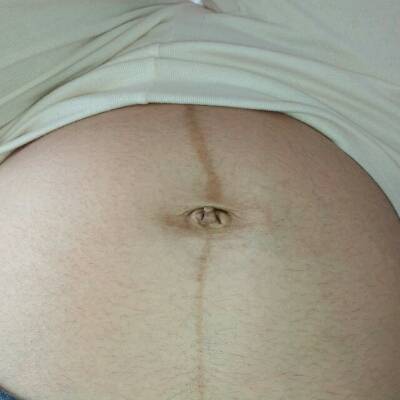 怀孕马上36周了,肚脐眼右边这个是妊娠纹么