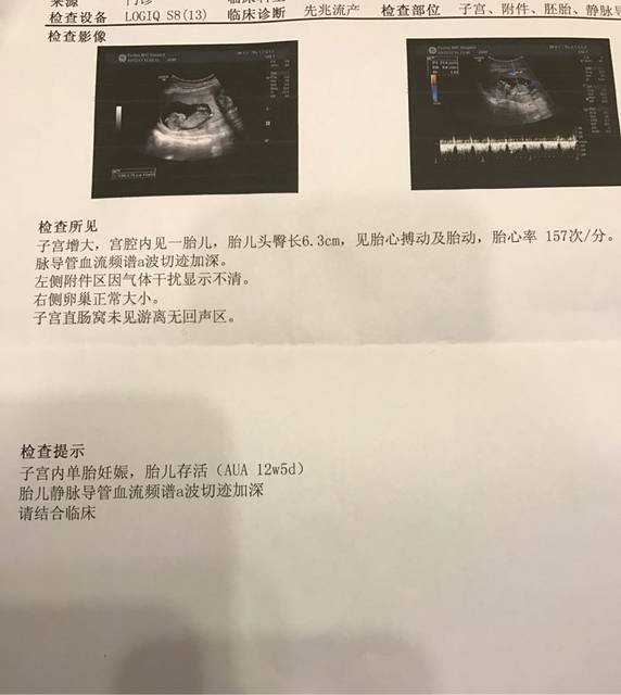 12周b超胎儿静脉导管频谱a波切迹加深