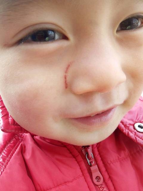 三周的宝宝脸被小朋友抓伤了,会留疤吗?_抓掉