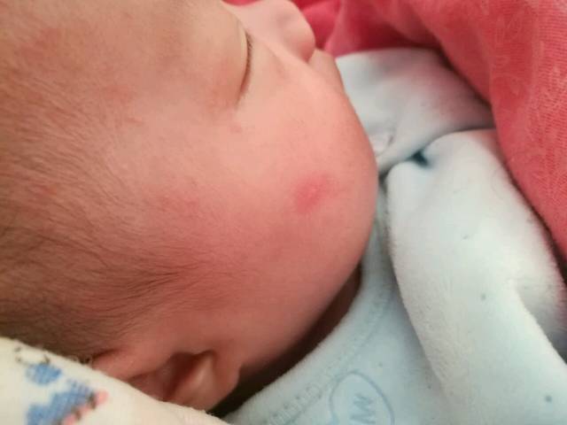 宝宝头上跟脸上长一些红红的不知道是啥,有懂