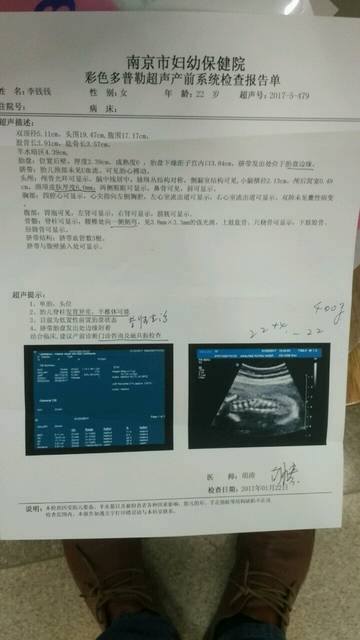 胎儿腰椎侧弯 半椎体_6个月了 宝宝以后生下来