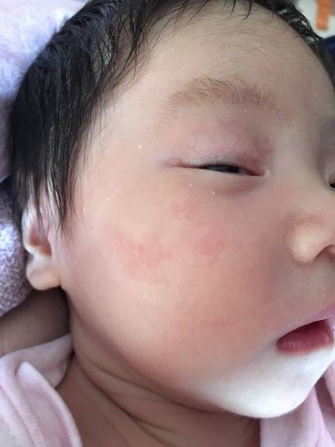 一个多月的宝宝脸上长了红斑怎么办