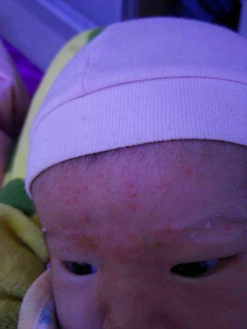 心疼宝宝_亲爱的宝妈们,湿疹是什么样的,看看