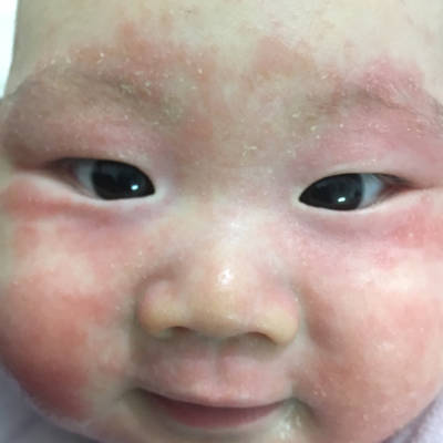 宝宝从三个月开始脸上 身上出湿疹 现在已经三