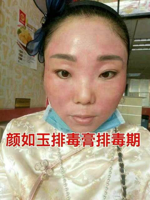 爆【激素脸蜕变成功】_【排毒膏拯救你的激素