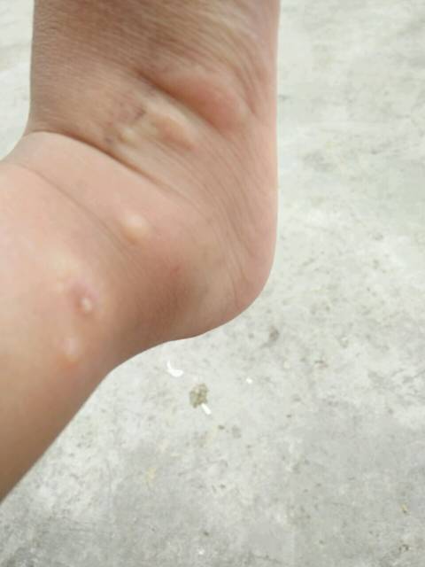 小孩身上长红疙瘩,痒后起水泡,有啥办法_小孩