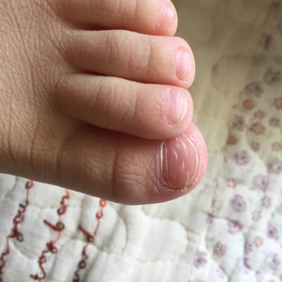 宝宝三岁,脚趾甲出现白色裂纹,是怎么回事?宝