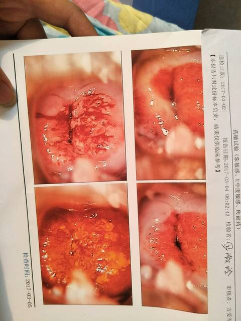 宫颈糜烂怎么办?