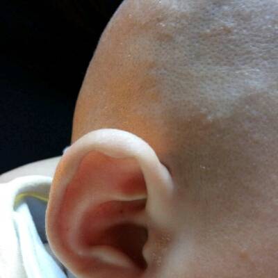 我家宝宝三个月三天,头上起了类似癣(图片上耳朵边上也有),想知道是怎