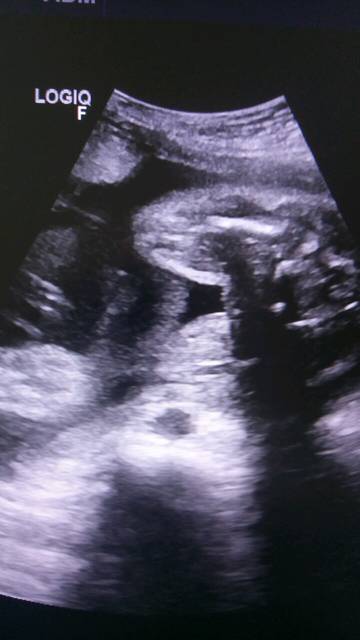 孕28周 ,b超图看男宝还是女宝?b超看男宝女宝?