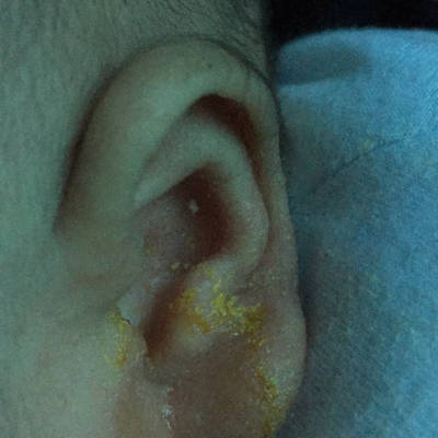 请问专家,宝宝耳朵上这是什麼,是怎麼引起的,去皮肤科,医生说是湿疹