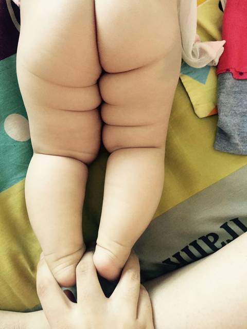 腿纹不正常。应不应该重视?_宝宝腿纹不正常