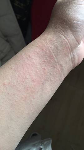 放疗后皮肤灼伤并且很痒怎样处理