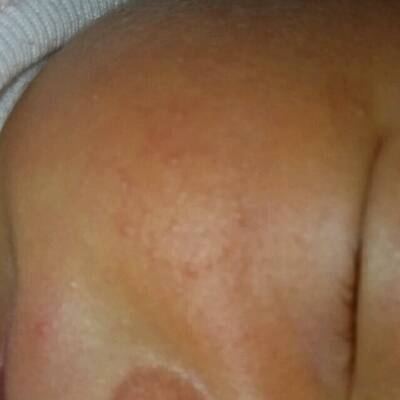 宝宝出生第八天,脸上长出一粒粒的小红点,这是湿疹还是痱子?