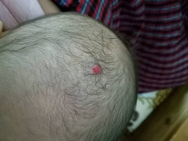 转两盒血管瘤药膏_上海第九人民医院配制