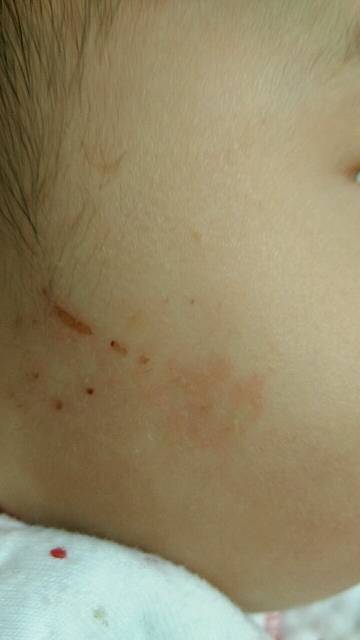 湿疹是什么样子的_湿疹是长这样的吗_宝宝树