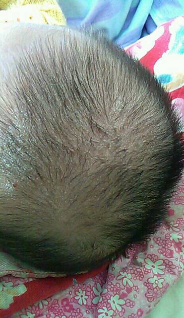 头皮_六个月宝宝头顶上头皮很多,后来发现结黄