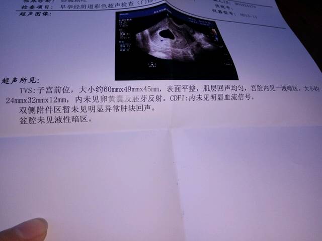怀孕45天了今天去做b超阴超都看不见胎囊_怀