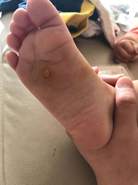 病毒性疱疹_宝宝两岁了 脚底长了一个水泡 特