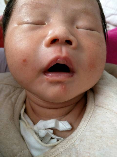 这是湿疹吗?_母乳喂养,没吃什么不能吃的东西