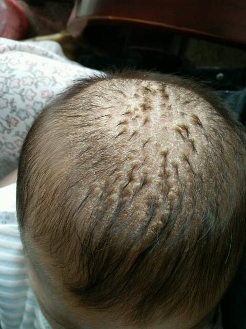 宝宝还未满三个月!掉头发