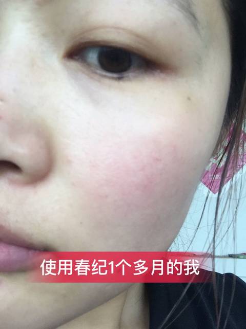 红血丝真的淡了_我有遗传性的红血丝,一直都很