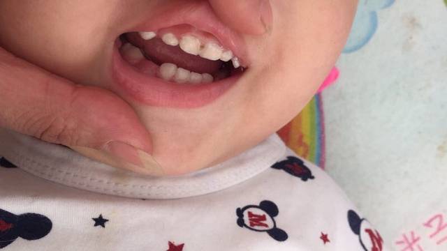 求帮助宝宝牙疼_17个月宝宝两颗门牙烂了个洞