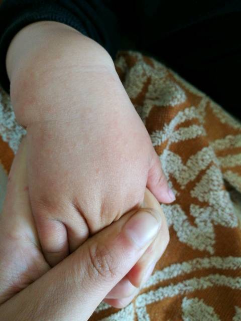 小疙瘩_宝宝手上起的很多小疙瘩,很痒,不知道