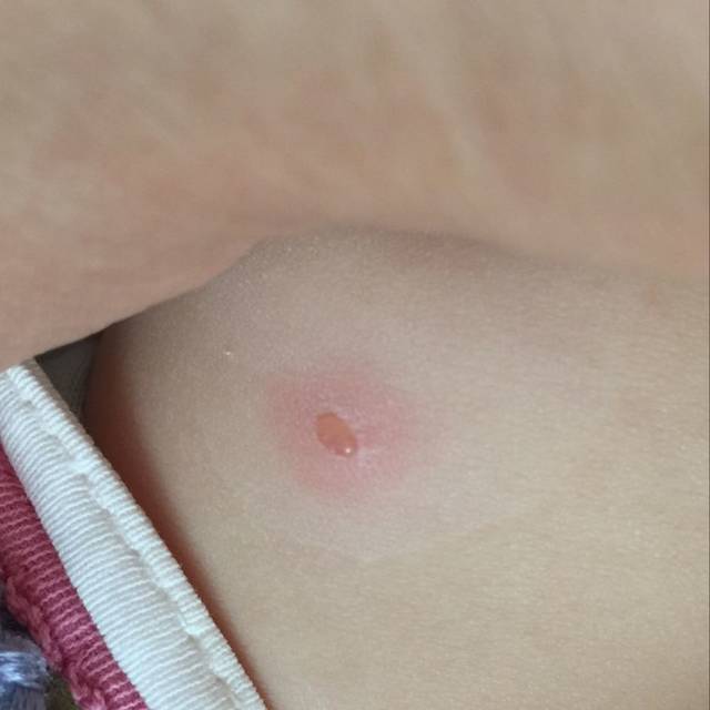 宝宝身上长水泡_宝宝昨天额头出现一个红点没