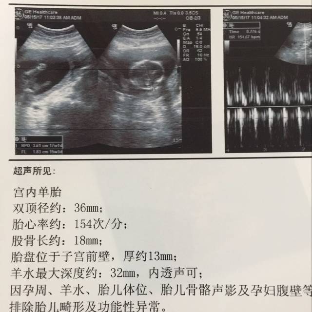 通过双顶径和股骨长 能判断男女吗