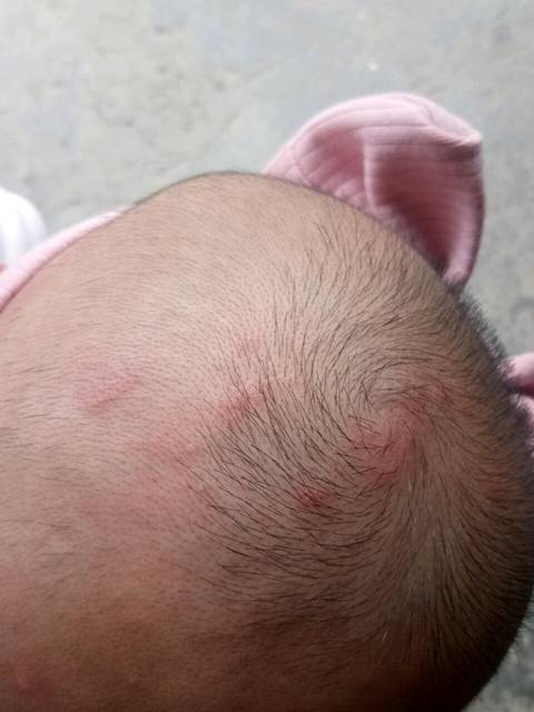 求助,麻烦大家看看这是什么_宝宝头上长了红疙