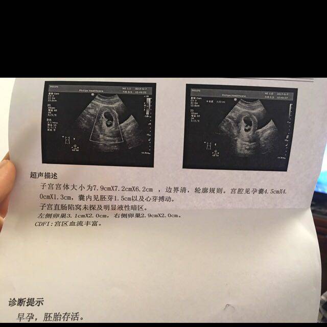 去年胎停,今年52天,见胎心胎芽_去年孕酮低,70