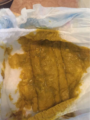 宝宝拉黄色黏液大便 三个月 母乳餵养 为什麼会有黏液