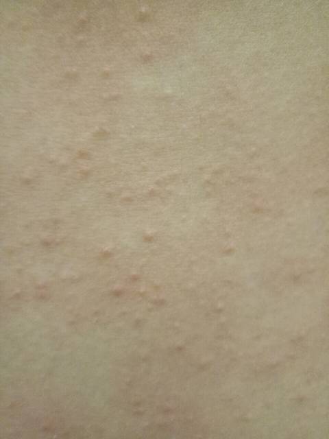求助:肚子的皮肤过敏起红疹很痒怎么办?