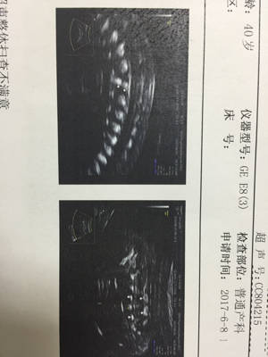 24周做的四维,超生描述,胎儿脊柱腰段部分椎体排列欠规则部分椎间隙增