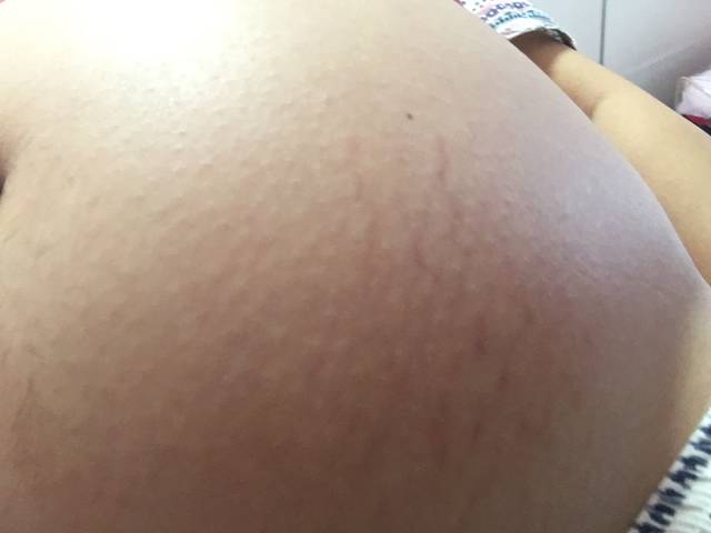 怀孕31周开始长妊娠纹了吗?