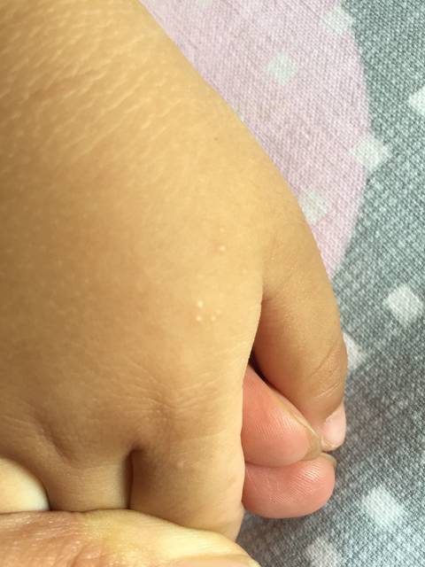 宝宝手背长了一片儿小米粒一样的小疙瘩,肤色