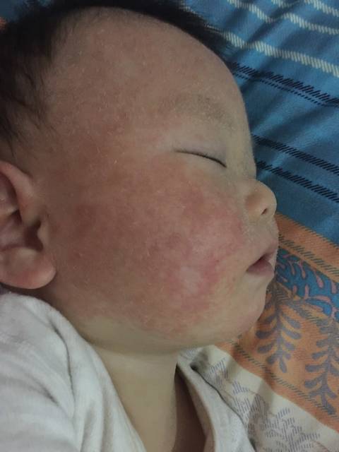 宝宝脖子湿疹擦爽身粉脱皮怎么回事?