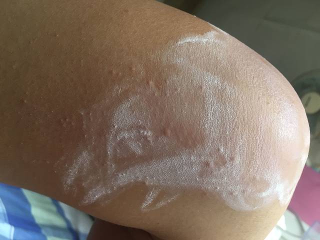 好烦好烦._怀孕5周+1天这几天身上居然起了湿