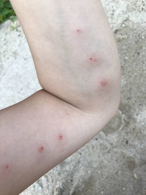 封闭抗体阴性,今天免疫治疗了