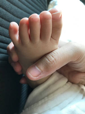 宝贝现在14个月,脚的小拇指外翻的很严重,需要治疗吗?