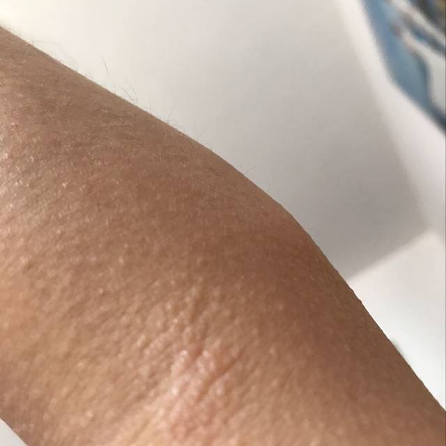 怀孕起皮炎了,用什么药膏,我去药店说药膏孕妇