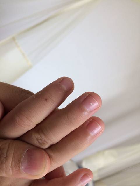 5岁宝宝指甲上有白点