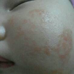 宝宝脸上出现红疹,温度高就多,温度低就消除部