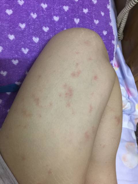 四个多月红斑根大腿部长合租女生之间图片