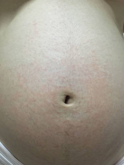 五个月肚子上起红疹,不痛不痒怎么办