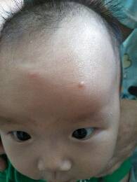 宝贝五个半月了之前幼儿急疹发烧退了后脸上额