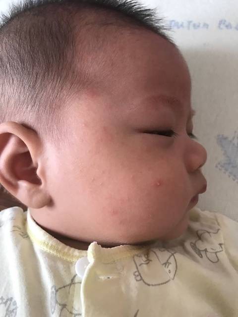 三个月宝宝退烧后脸上长红疹_宝宝前两天退烧